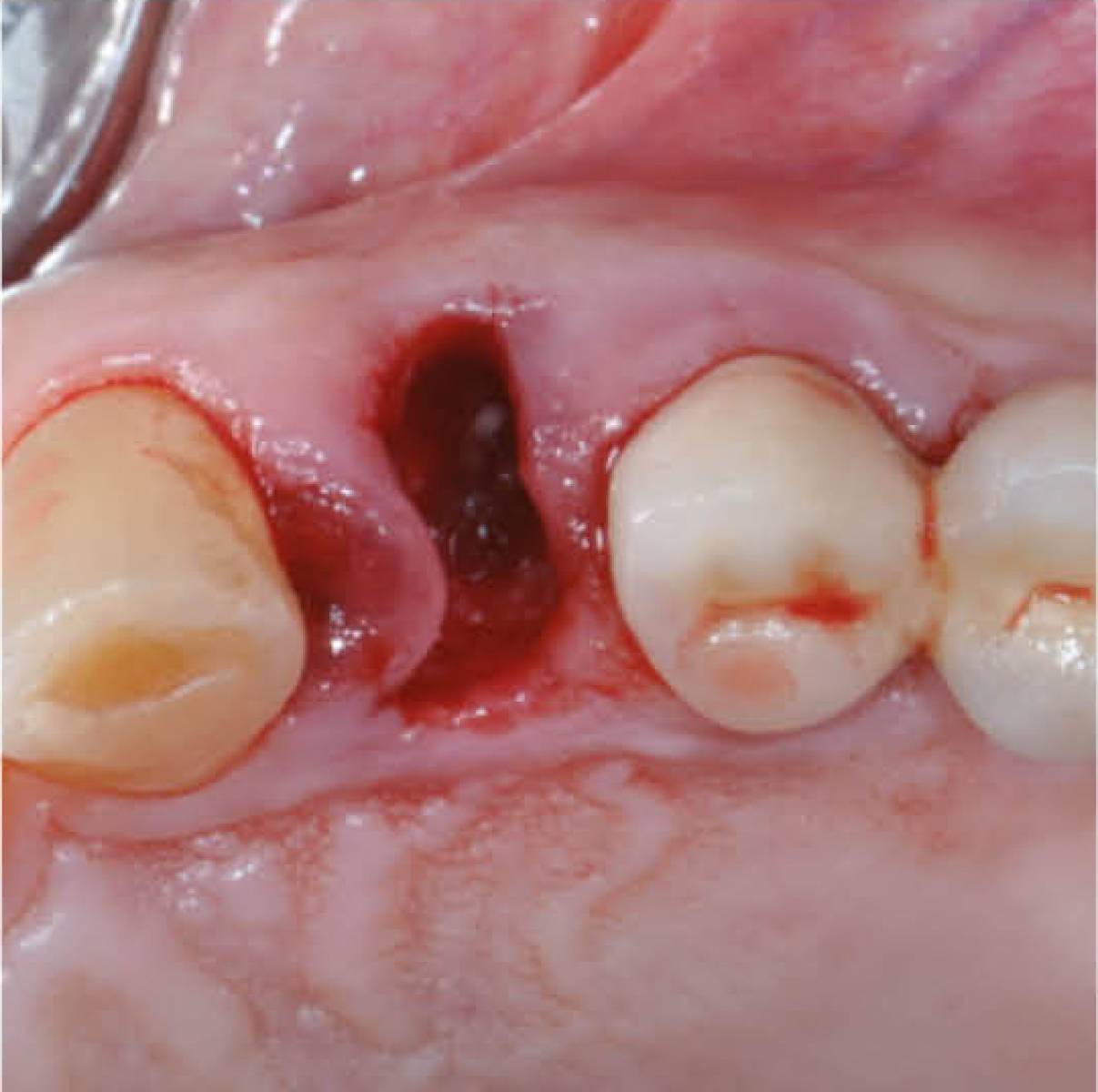 TRI Dental Implants matrix®