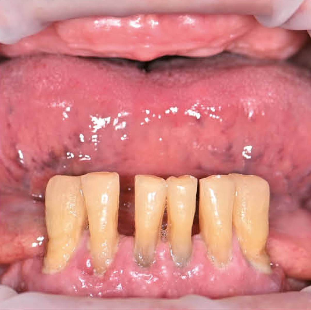 TRI Dental Implants matrix®